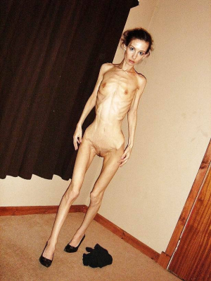Naked Anorexic Girl Is Beyond Skinny