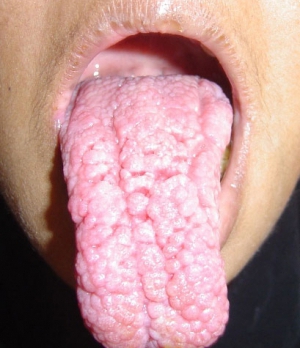 diseased tongue