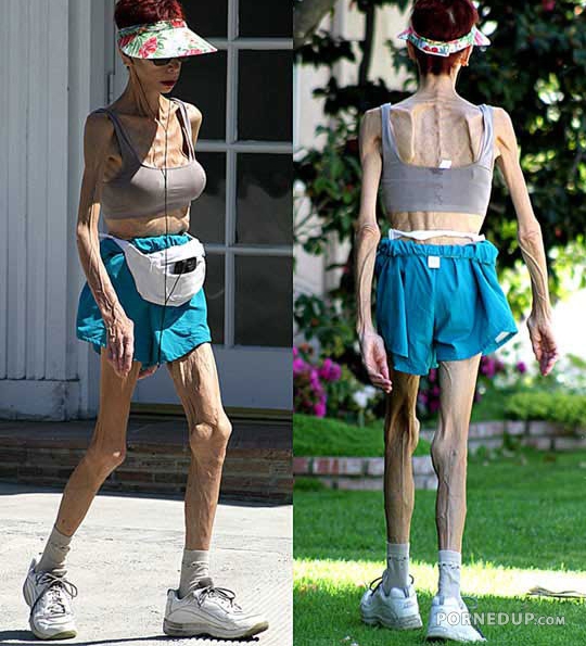 anorexic woman going for a walk