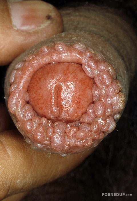 diseased cock