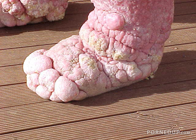 diseased foot