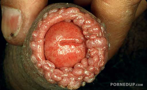 Disgusting Wart Dick Porned Up