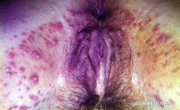 Diseased Pussy Porn