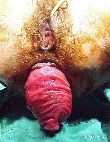 prolapsed rectum