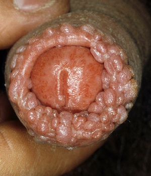 diseased cock
