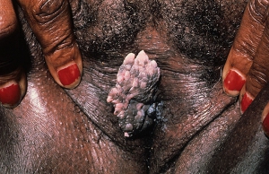 diseased pussy diseased pussy