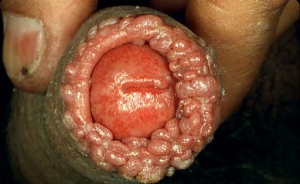 disgusting wart dick disgusting wart dick