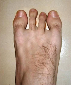 fucked up foot with 4 toes and two big toes