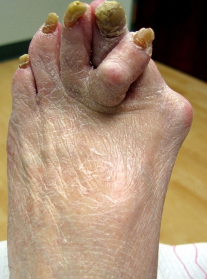 gross foot with bunion