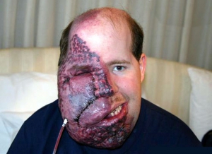 guy with fucked up red face guy with fucked up red face