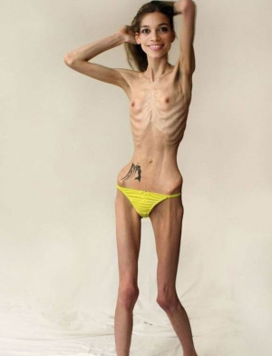 topless anorexic