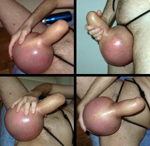 weird saline injected cock and balls weird saline injected cock and balls