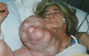 woman with huge tumor growing out of her neck