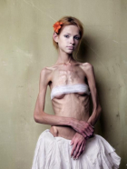 Anorexia Model