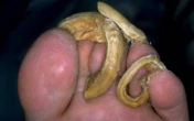 Gross long toe nails