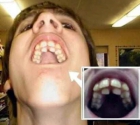 Guy has two sets of front teeth