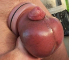 Huge ballsack filled with silicone