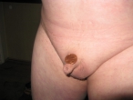 Micro Penis The Size Of A Penny