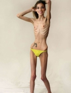 Topless anorexic